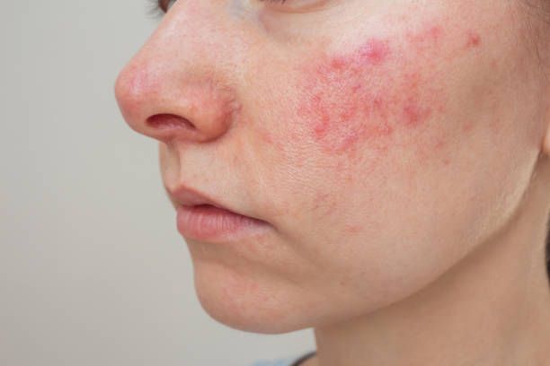skin rashes treatment in Dubai