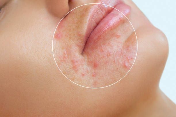 Acne Scar Treatment in Dubai