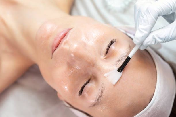 Chemical Peels in Dubai