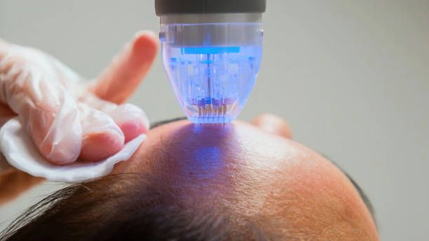 Derma Roller Treatment in Dubai