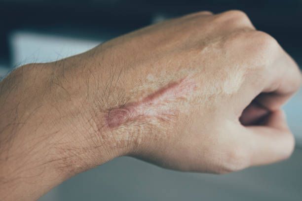 Hypertrophic Scar Treatment in Dubai