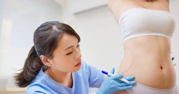 Liposuction in Dubai