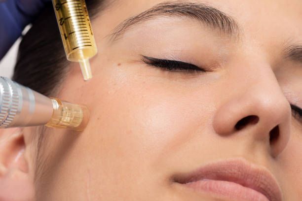 MesoGold Treatment in Dubai