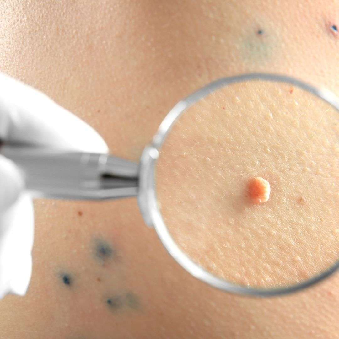 Mole Removal in Dubai
