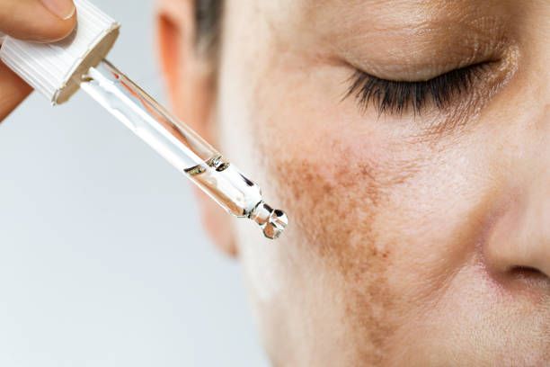 Skin Whitening in Dubai