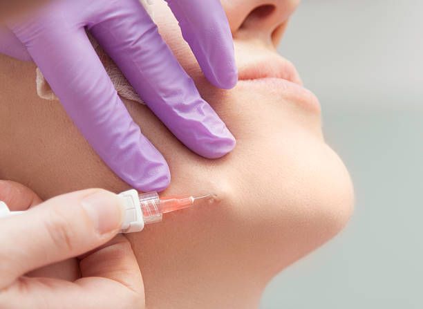 Belotero Fillers in Dubai