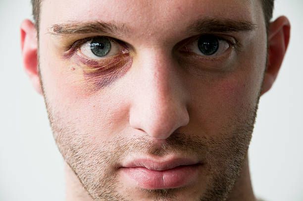 Under Eye Fillers in Dubai
